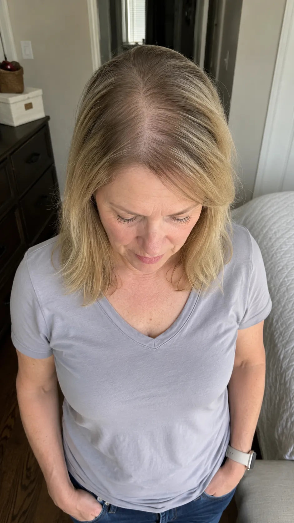 Woman hair loss example